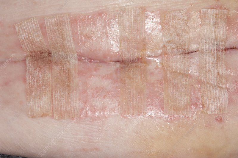 The Role of Steri-Strips in Wound Healing