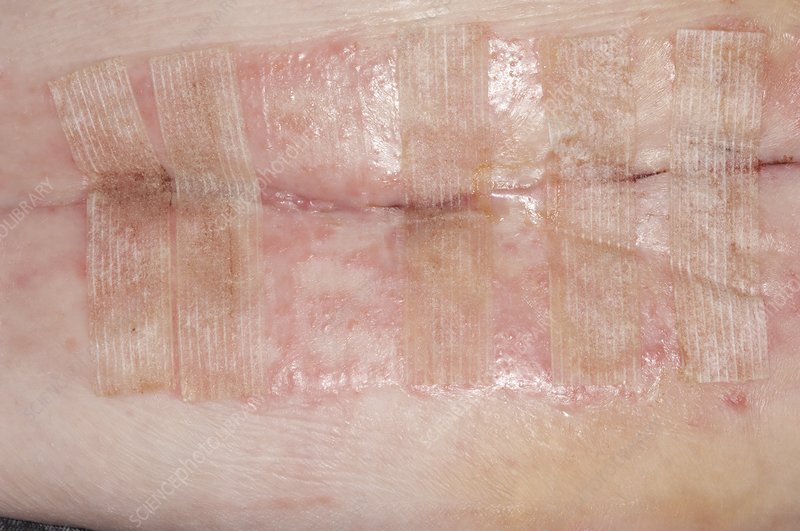 How Long Do Steri Strips Stay On After CSection? A Comprehensive Guide