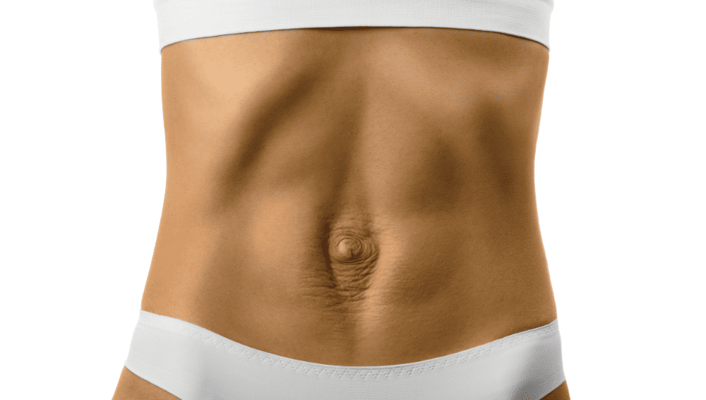 Symptoms of Diastasis Recti