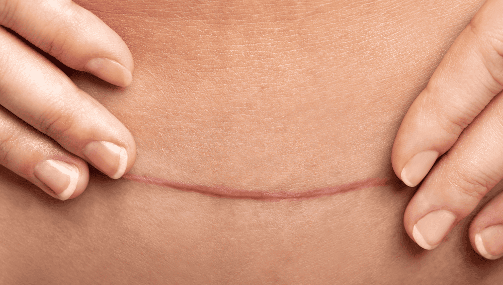 Challenges of Keeping Incision Dry When Overweight