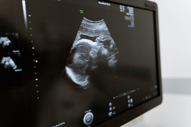 why does my baby's nose look so big on ultrasound