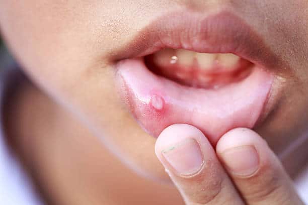 Understanding Canker Sores