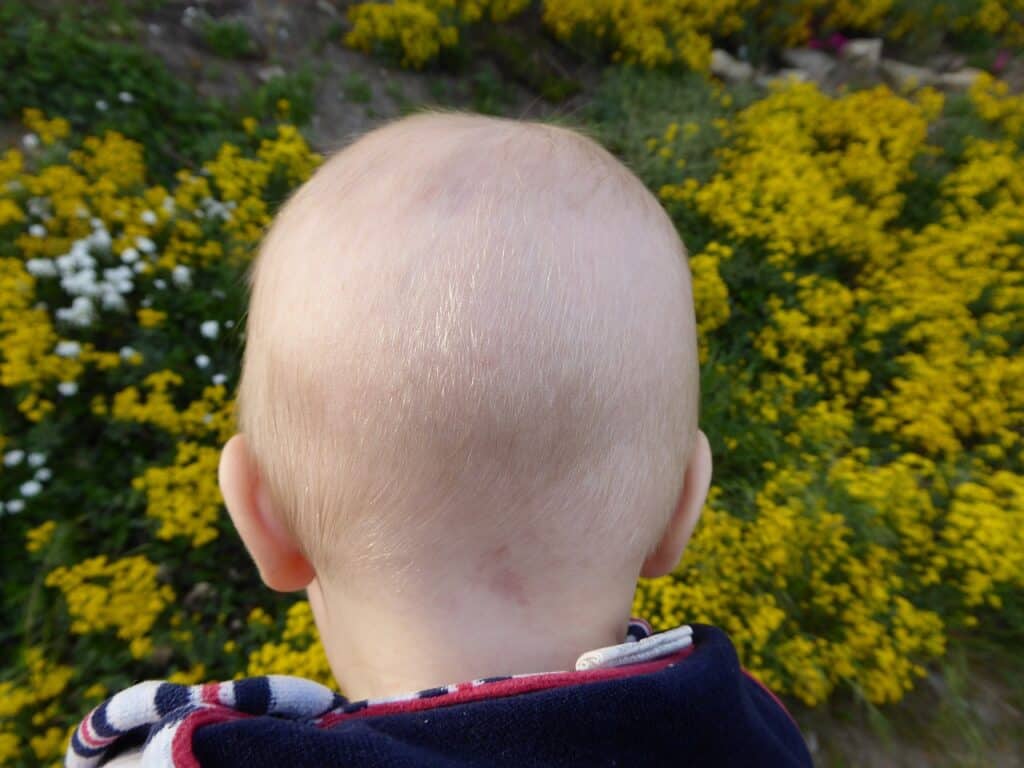 Hair Loss in Babies