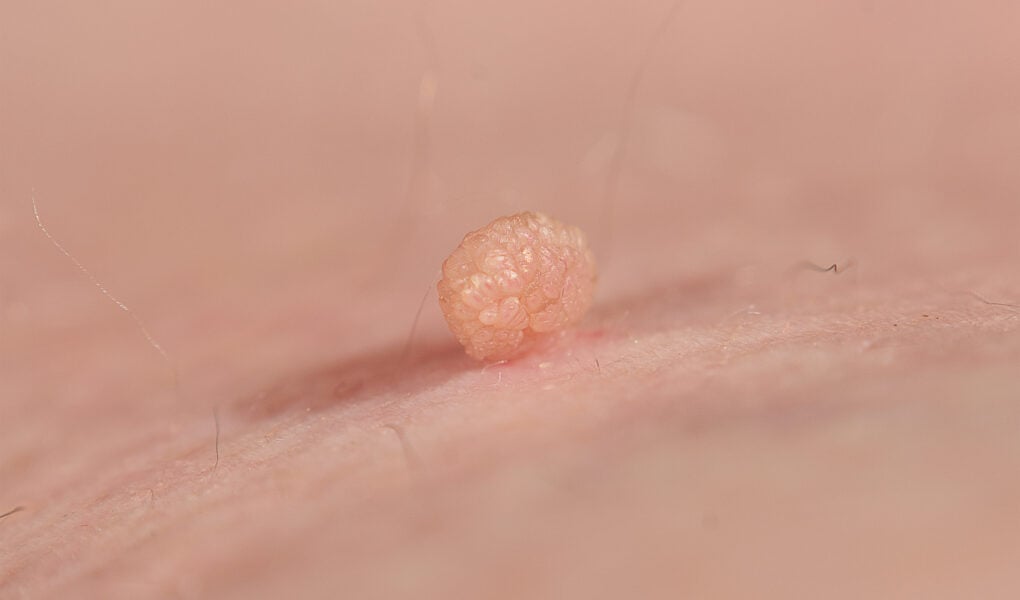Skin Tag on Areola During Pregnancy