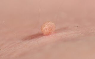 Skin Tag on Areola During Pregnancy