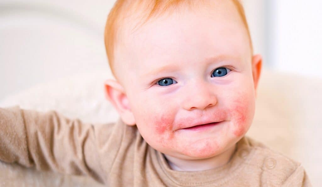 Understanding Eczema in Babies