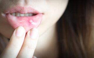 canker sore during pregnancy