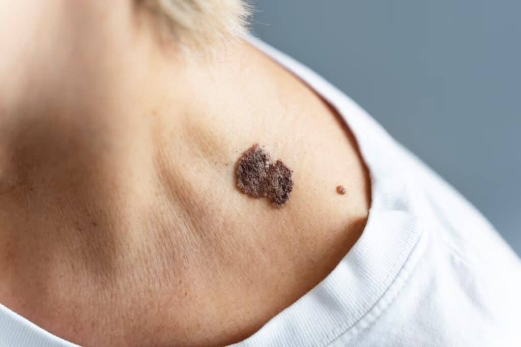 skin tag on nipple during pregnancy